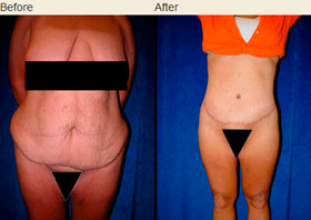 Body lift (Lower body lift, Belt lipectomy) - Dr. Rodriguez