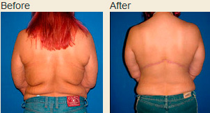 Patient before (left) and after (right) a male-pattern upper body lift.
