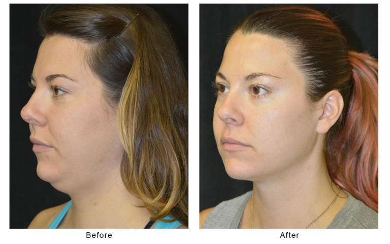 Double Chin Reduction In Boston Ma Dr Christopher J Davidson