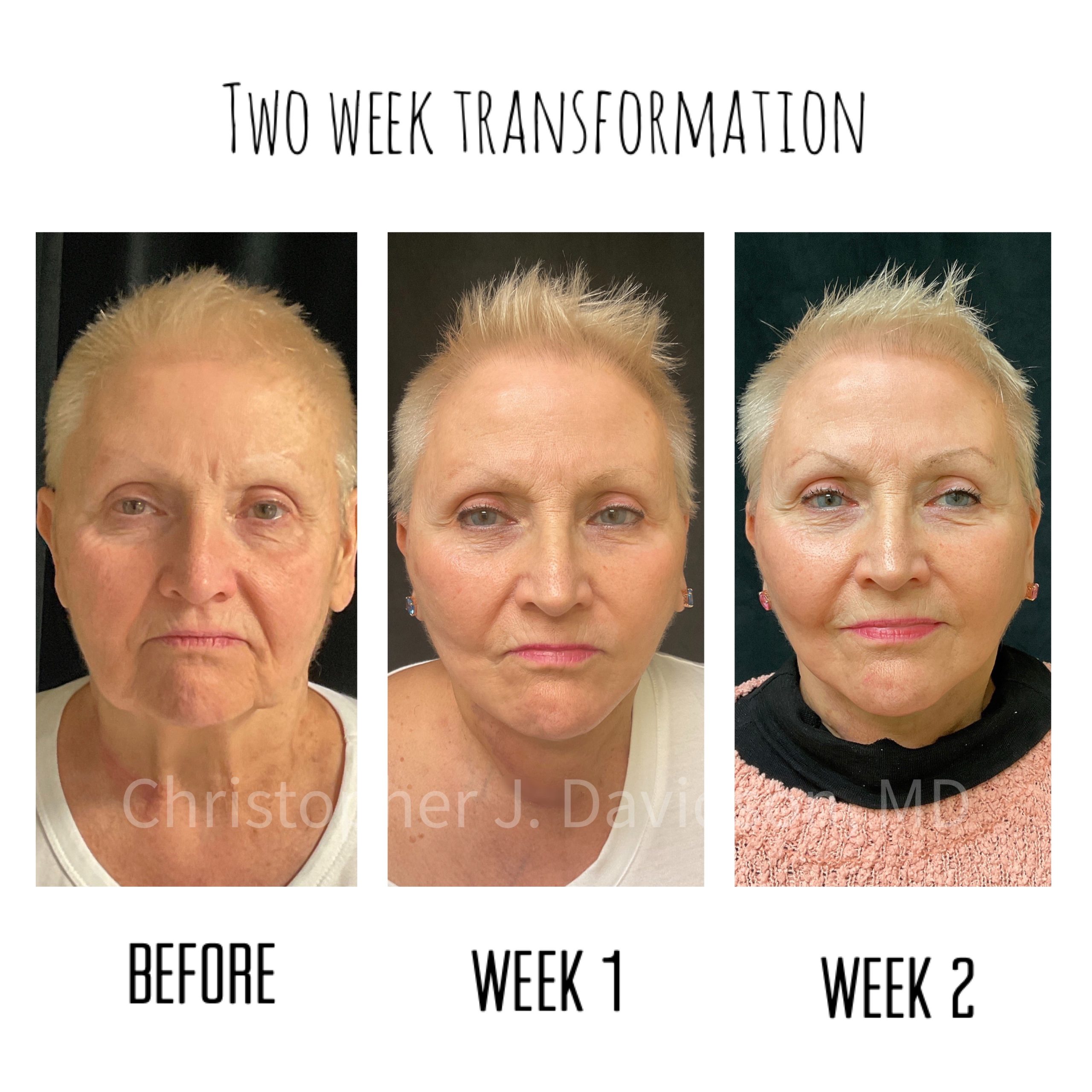 Dr. Davidson's facelift patient 2-week transformation: minimal downtime, immediate improvement with beautiful results after just 2 weeks