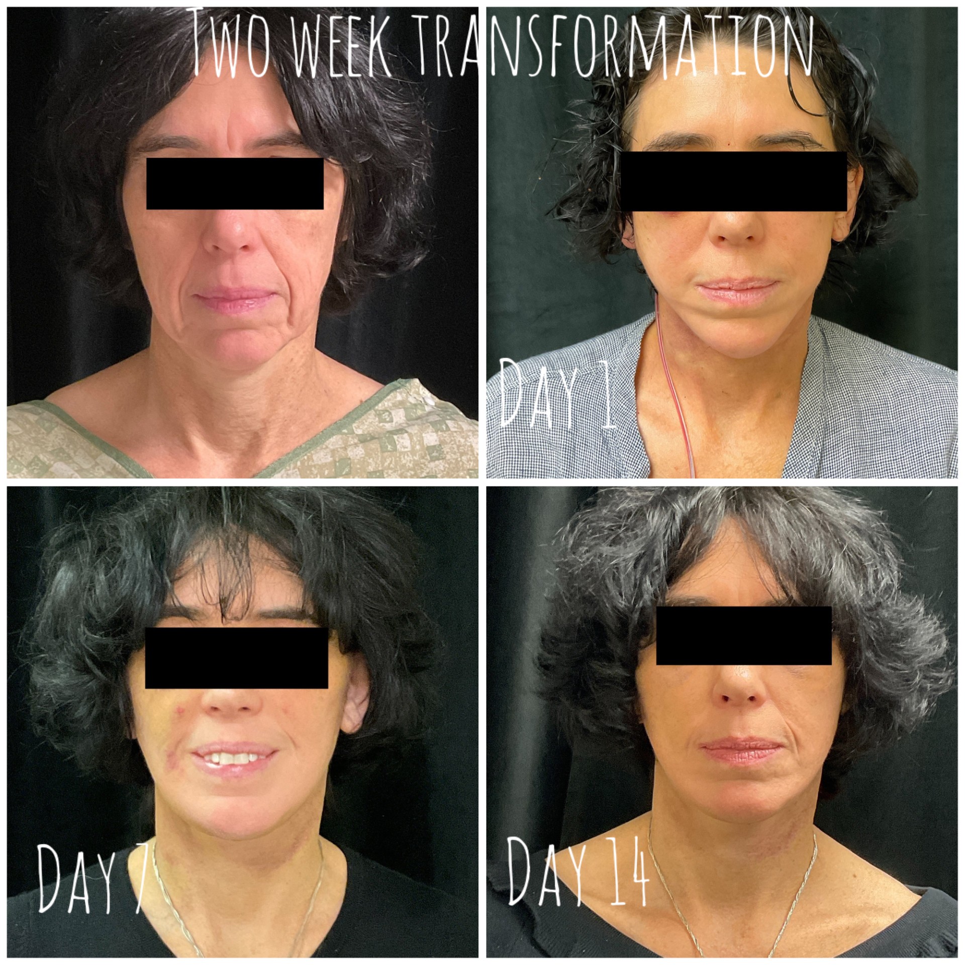 Dr. Davidson performed a facelift on this patient, and her results are beautiful after just 2 week! Photos show the patient before her facelift, 1 day after, 1 week after, and 2 weeks after surgery.